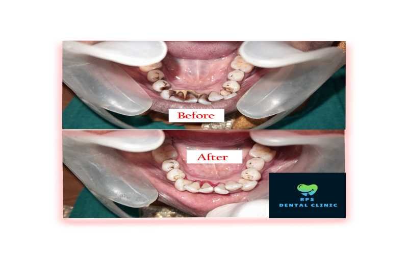 Cosmetic Dental Treatment Plan For Tobacco and Gutka Chewing Stains