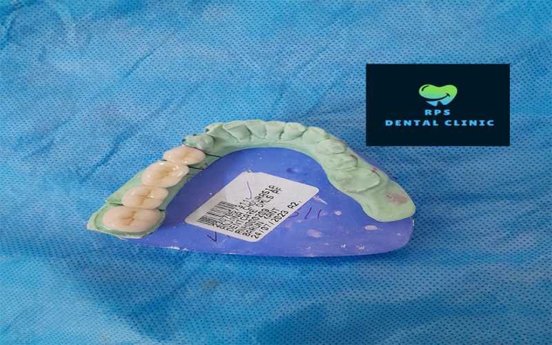 How Patients Determine the quality of fix denture teeth