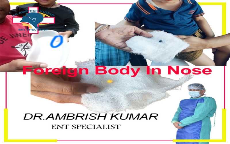 Foreign Body In Nose