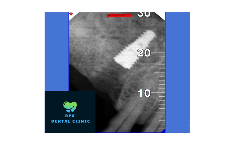 Dental implant cost and treatment in the dental office