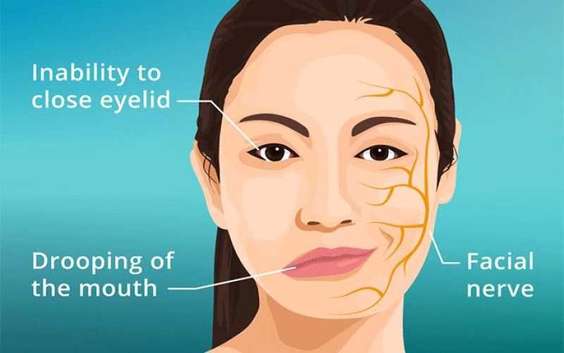 Facial/ Bell's Palsy
