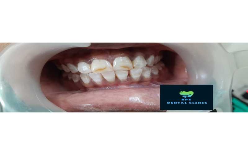 Cosmetic Dental Treatment