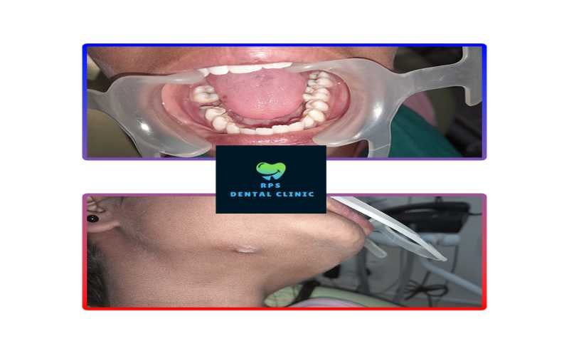 Infection in the maxillofacial Region