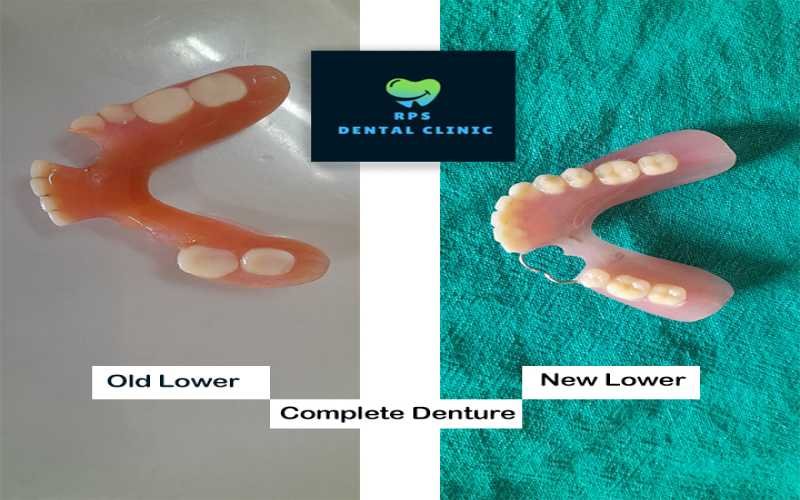 Lower Complete Denture