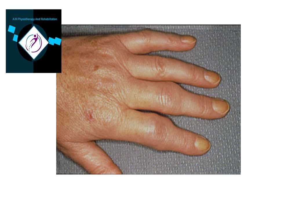 Rheumatoid arthritis