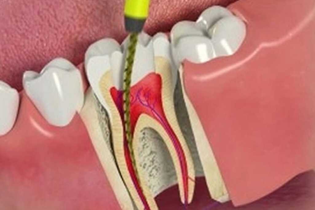 ROOT CANAL TREATMENT