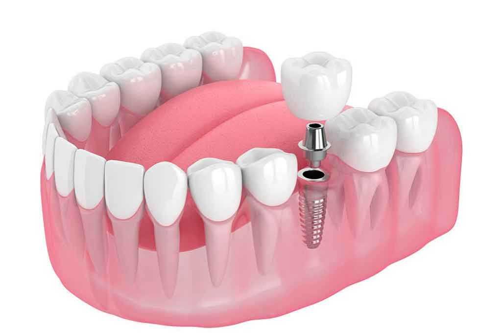 DENTAL IMPLANT