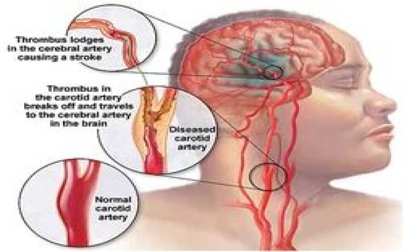 Stroke/paralysis