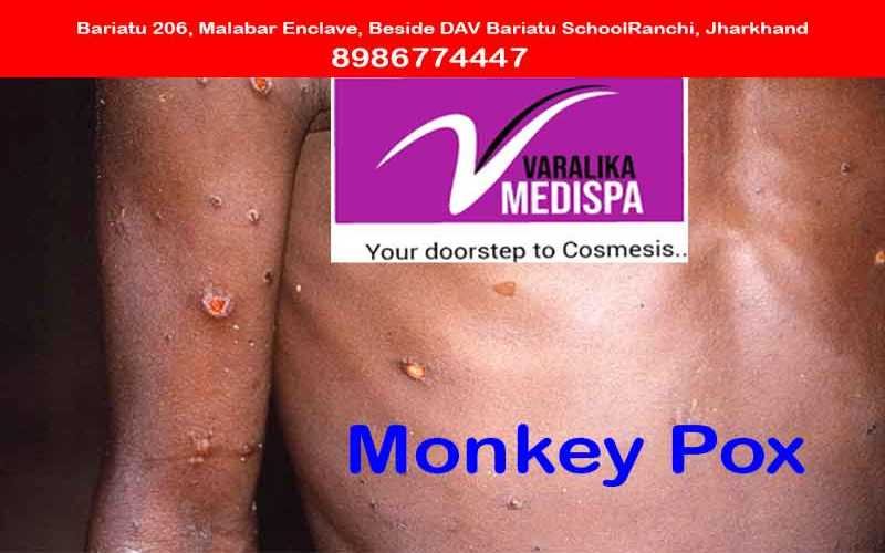 Monkeypox