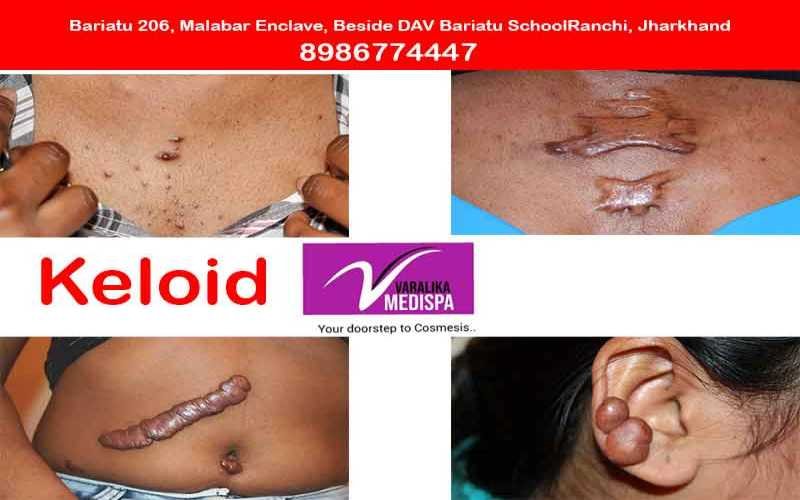 Keloid