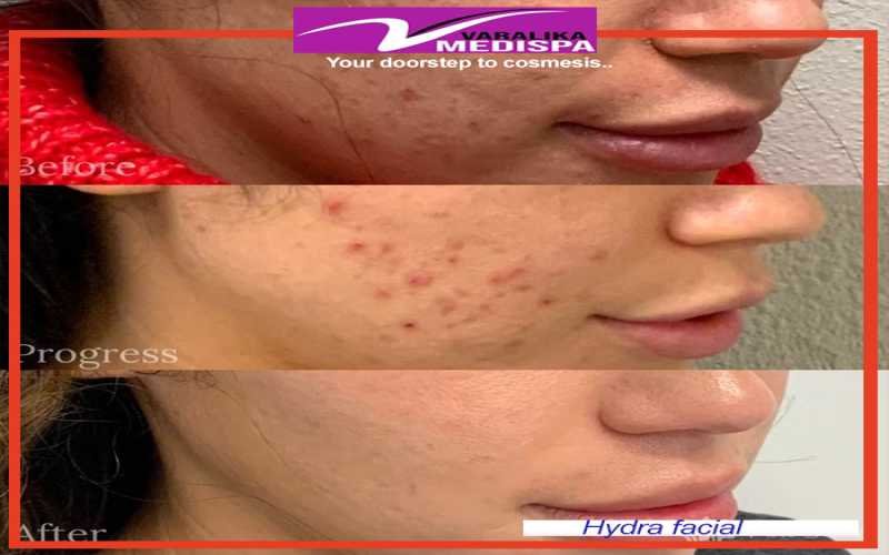 Looking for a HydraFacial in Ranchi ?