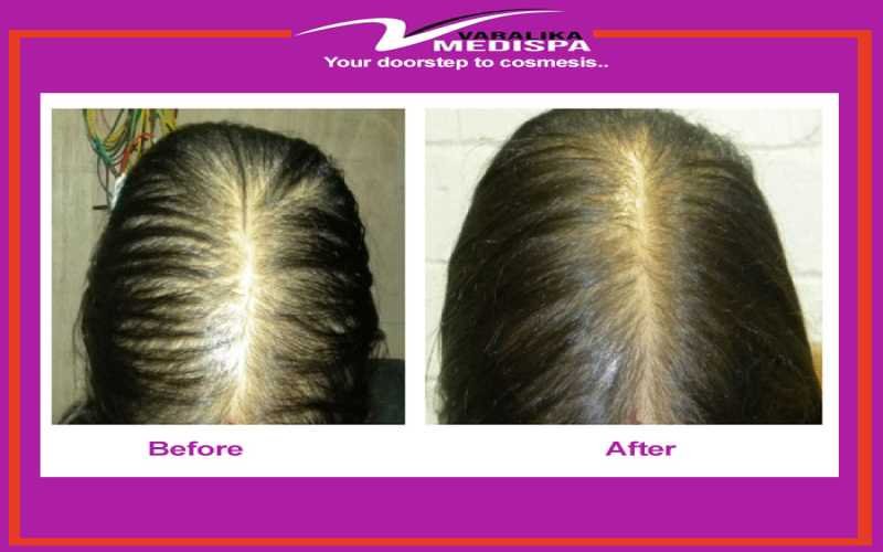 Hair Fall Specialist at Varalika Medispa