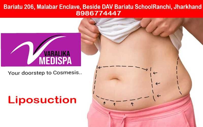 Liposuction