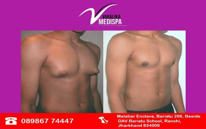 Gynaecomastia