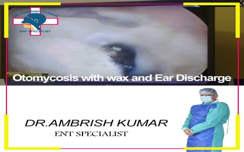 what is Otomycosis