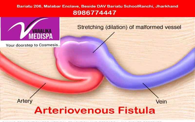 Arteriovenous Fistula
