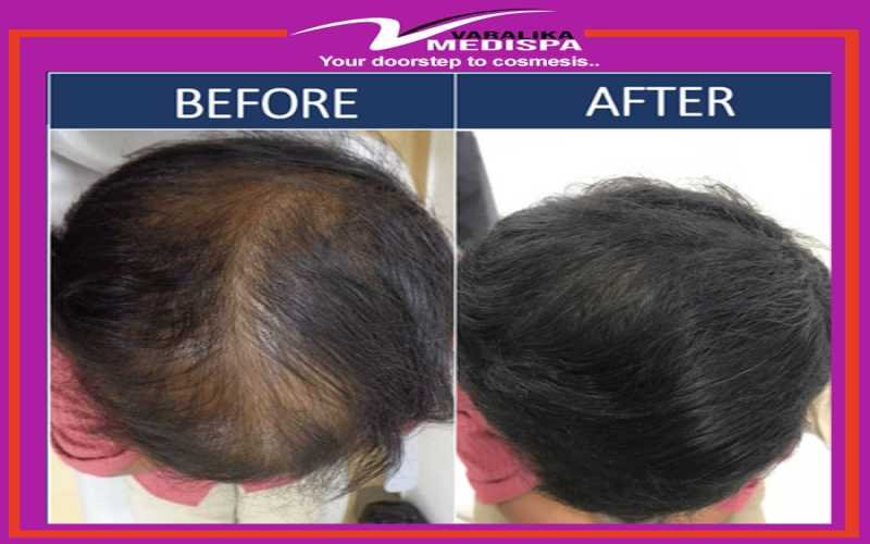 Hair specialist clinic in Ranchi