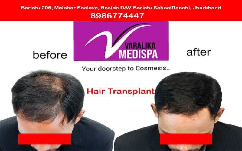 Hair Transplant