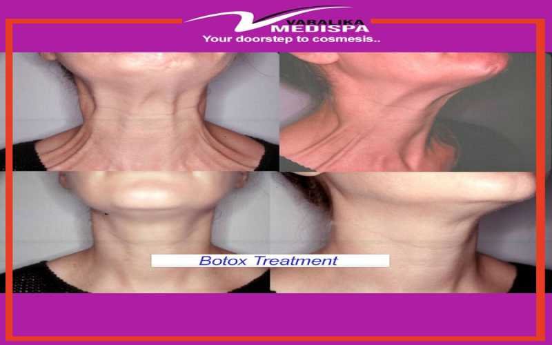 Botox in Ranchi