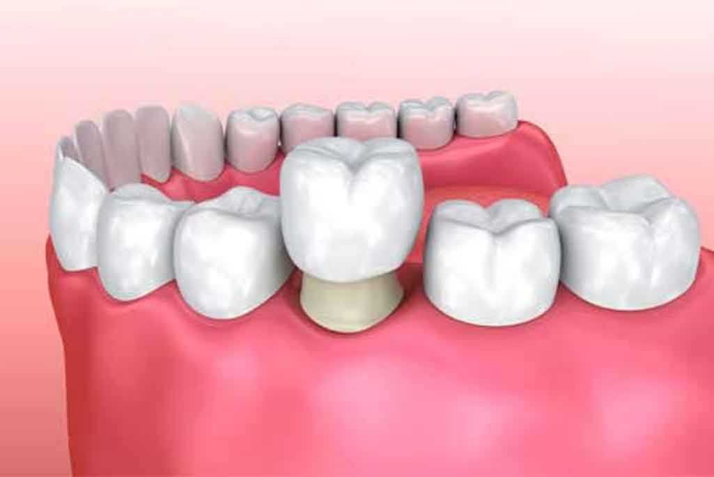 DENTAL CAP