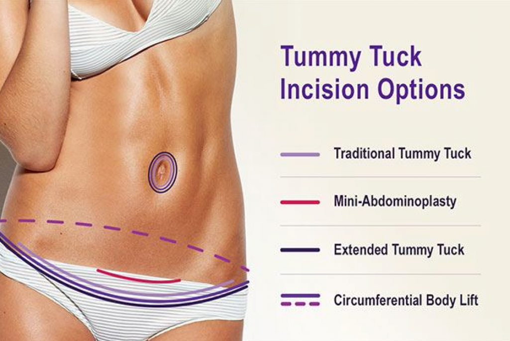 Tummy Tuck Treatment