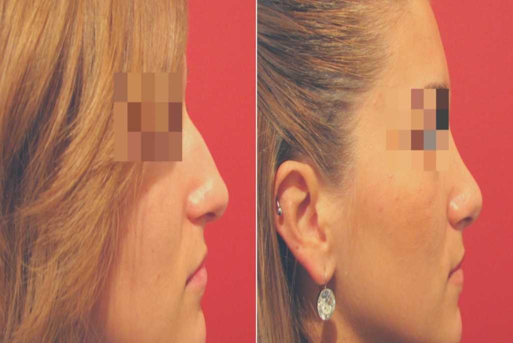 Rhinoplasty Treatment