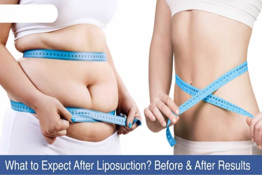 Liposuction Treatment