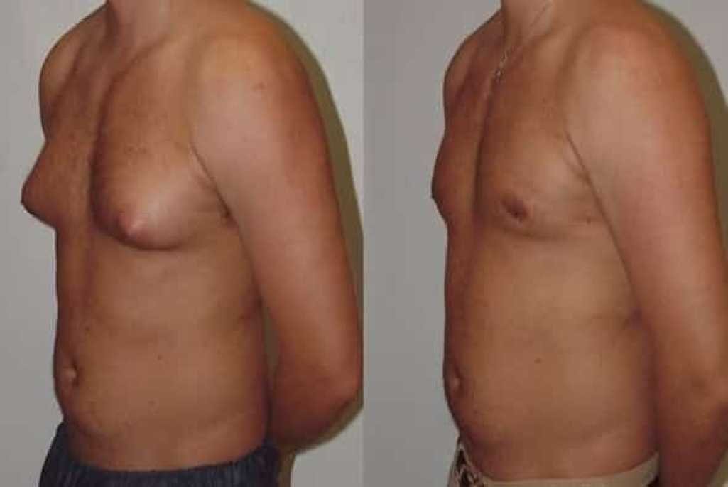 Male Breast Reduction