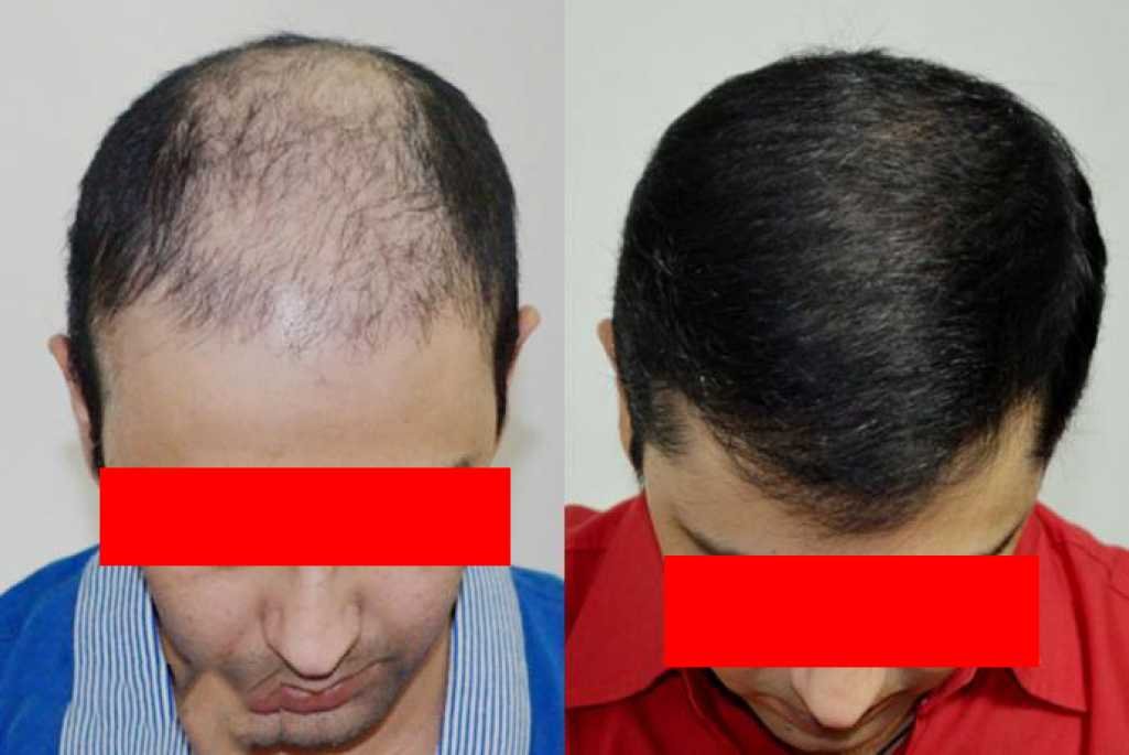 Hair Transplant